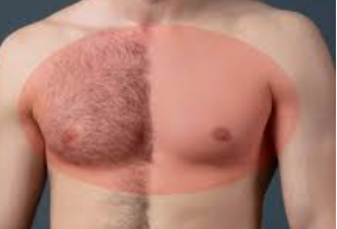 LASER ELITES - BODY I