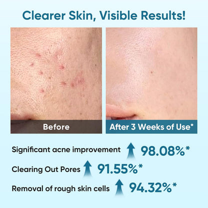 Acne Exfoliating Toner Pads Glycolic 10% Salicylic 2% Niacinamide