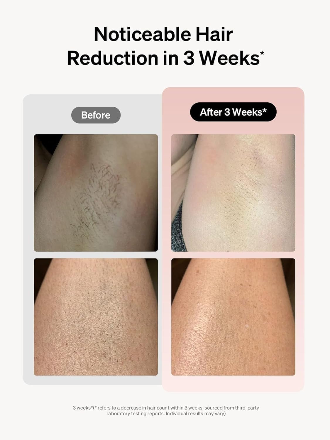 Women's IPL Laser Hair Removal Device with Ice-Cooling Technology - Pink